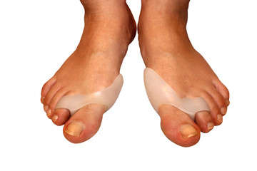 Medecin, valgus bunion, leg with deformation valgus hallux (Bunion), consequence of failure of treatment, silicone separators for toes, isolated on white background with clipping path, place for text