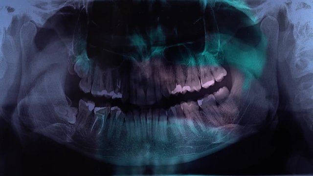 Doctor shows a teeth in a x-ray picture. A dentist holding an x-ray while looking. Closeup of dentist looking at dental x-ray plate examines the dental arch.