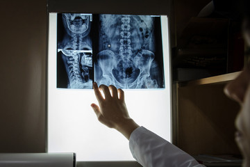 Close up view picture of doctor exploring spinal x-ray: lumbar and cervical region - first 2...
