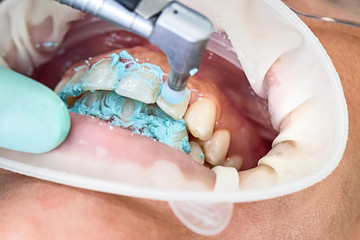 Zähne polieren beim Zahnarzt - 245616577