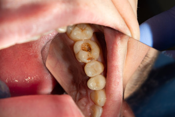 Dental caries. Filling with dental composite photopolymer material using rabbders. The concept of...