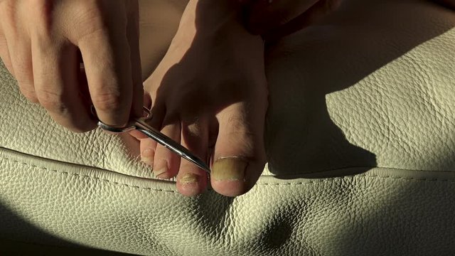 Fungus infection on nails