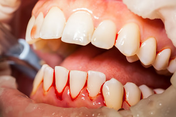 Zahnreinigung, Zahnfleischbluten - 245625565