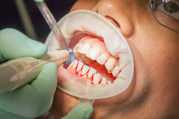 Zahnreinigung, Zahnfleischbluten