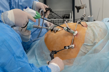 Endoscopy. Laparoscopy. The hands of doctors using laparoscopic instruments perform surgery in the abdominal cavity of a fat man or a pregnant woman. Modern advances in medicine. Endovideosurgery.