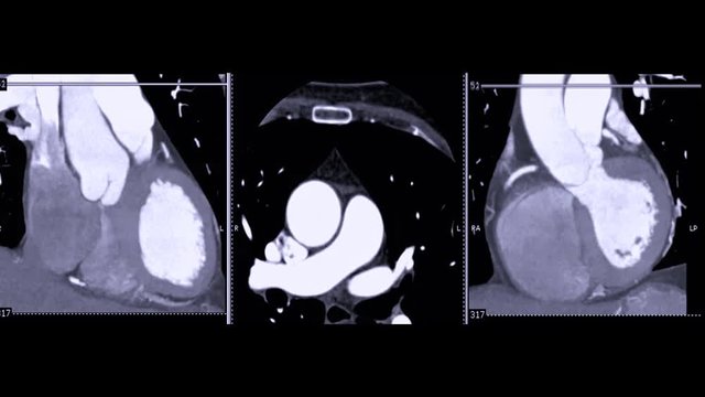 CT Angiography of Coronary artery  ( CTA ) comparison  Coronal Oblique view and axial view with MIP method  show anatomical of the heart.