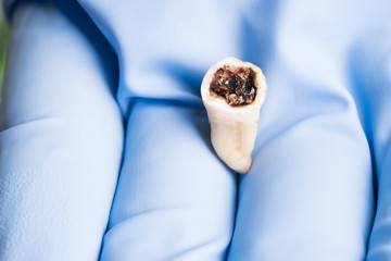Extracted rotter molar isolated in dentist’s hand with blue medical glove 
