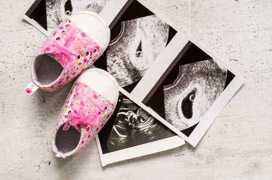 Pink booties next to pictures of the baby with ultrasound at 4 and 20 weeks of pregnancy. The concept of expecting a baby girl, pregnancy. Daughter. Selective focus.