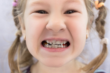 Adult permanent teeth coming in front of the child's baby teeth: shark teeth.