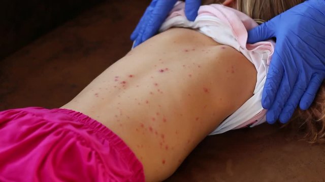 Chickenpox Rash Examination by Doctor in Blue Gloves