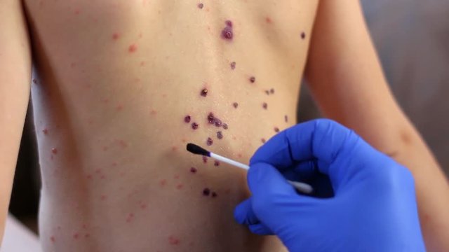 Chickenpox Blisters Lubricated with Antiseptic Drug with Cotton Swab 