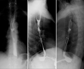 X-ray of the upper gastrointestinal series (UGI) with barium. Cancer of the esophagus. 