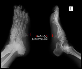 X-ray of the foot. Exostosis of the 5th metatarsal bone. Marker.