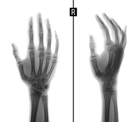 X-ray of the hand. Fracture of the base of the 1st metacarpal bone. Negative.