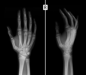 X-ray of the hand. Fracture of the base of the 1st metacarpal bone.