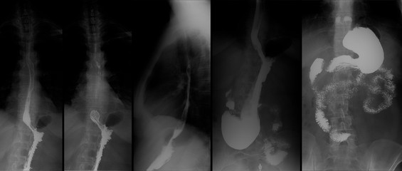 X-ray of the upper gastrointestinal tract (UGI) with barium. Hiatal hernia. 