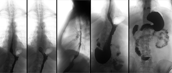 X-ray of the upper gastrointestinal tract (UGI) with barium. Hiatal hernia. Negative. 