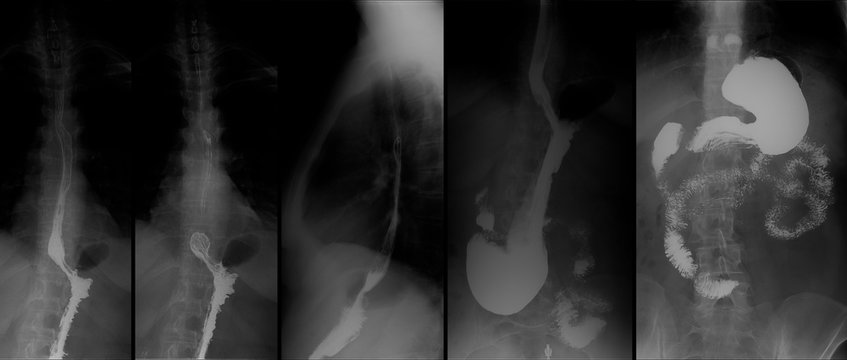 X-ray Of The Upper Gastrointestinal Tract (UGI) With Barium. Hiatal Hernia. 