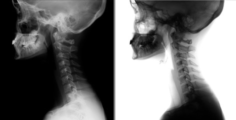 X-ray of the cervical spine. Kimerly anomaly. 