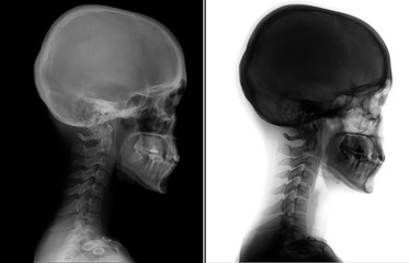 X-ray of the cervical spine. Kimerly anomaly. Cervical dysfunction. 