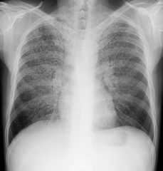 X-ray of the lungs. Miliary tuberculosis. 