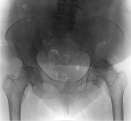 X-ray of the pelvis. Left-sided deforming arthrosis. Aseptic necrosis of the femoral head. Negative.