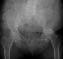 X-ray of the pelvis. Left-sided deforming arthrosis. Aseptic necrosis of the femoral head.