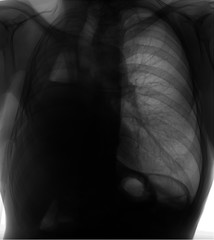 X-ray of the lungs. Right-sided pneumonectomy. Negative.
