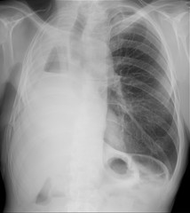 X-ray of the lungs. Right-sided pneumonectomy. 