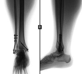 X-ray of shin. Consolidated fracture of the ankles with metal. Negative.