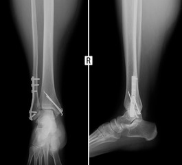 X-ray of shin. Consolidated fracture of the ankles with metal. 