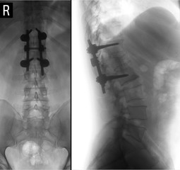 X-ray of the lumbar spine. Compression fracture of the vertebral body L1. Spinal fusion. Negative.