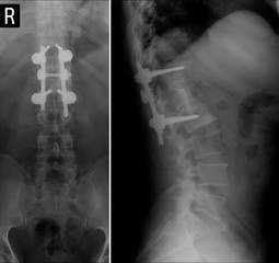 X-ray of the lumbar spine. Compression fracture of the vertebral body L1. Spinal fusion.