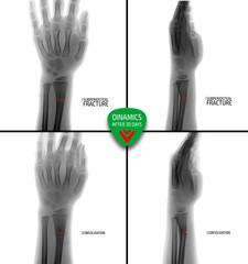 X-ray of the wrist. Subperiosteal fracture of the radius. After 30 days. Сonsolidation. Marker. Negative.