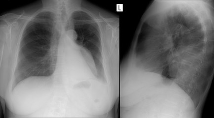X-ray of the lungs. Volume formation of the mediastinum. Enterogenous cyst. 