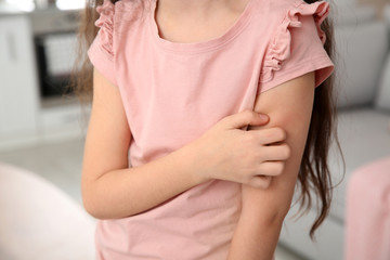 Little girl scratching arm at home, closeup. Annoying itch