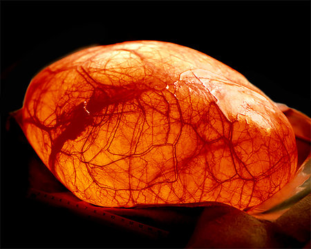 Huge ovarian cyst transilluminated