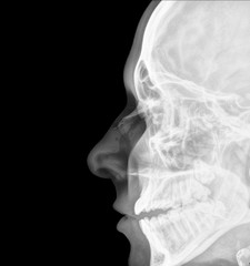 X-ray of a fracture of the nose
