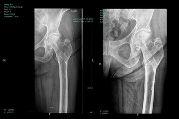 Fototapeta na wymiar Femoral head necrosis and progress of the healing process of greater trochanter fracture