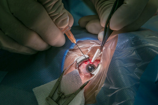antiglaucoma Implant
