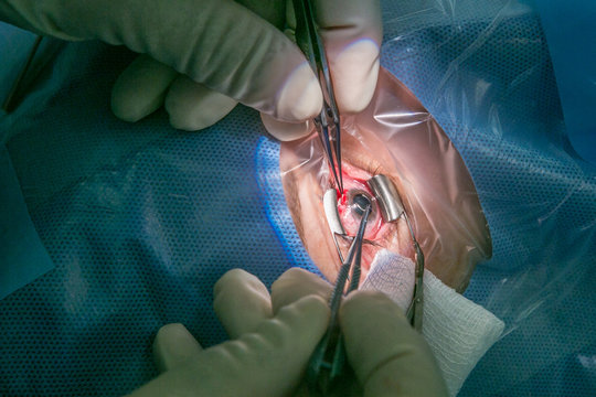 sewing scleral lobe