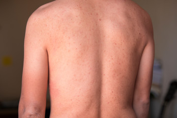 Concepts health problems, , skin diseases, a man showing his back with red spots, acne
