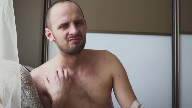 Allergies to the neck and shoulders. Man with psoriasis is touching his dry, itchy, and scaly skin on neck.