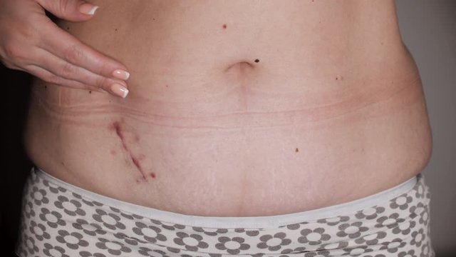 Woman showing the stomach with a appendicitis scar after surgery. Scar removal