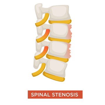 Spinal stenosis spine disease or vertebral illness