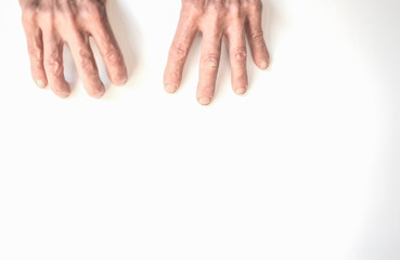 Fingers of elderly men with rheumatoid arthritis and bones on th