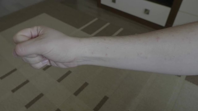 Young man looking on his arm with smallpox viral disease marks on skin