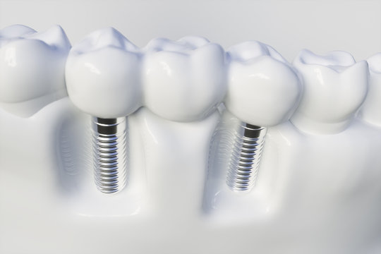 Tooth human implant - 3D Rendering