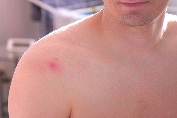 Big red pimple on a man's shoulder close-up view.