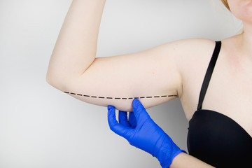 A plastic surgeon is preparing to tighten the skin of the hands. Brachioplasty - plastic arms,...